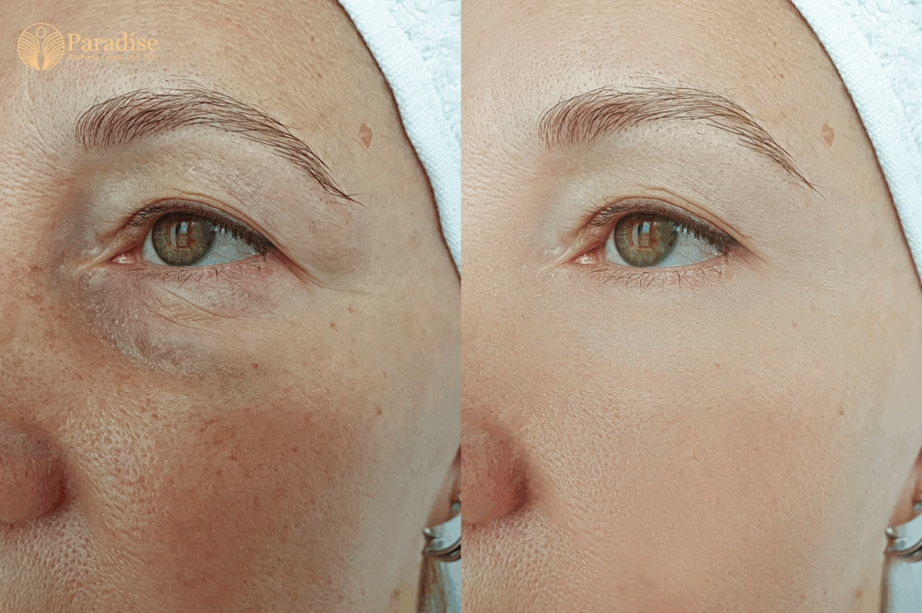 hydra facial treatment after face glow