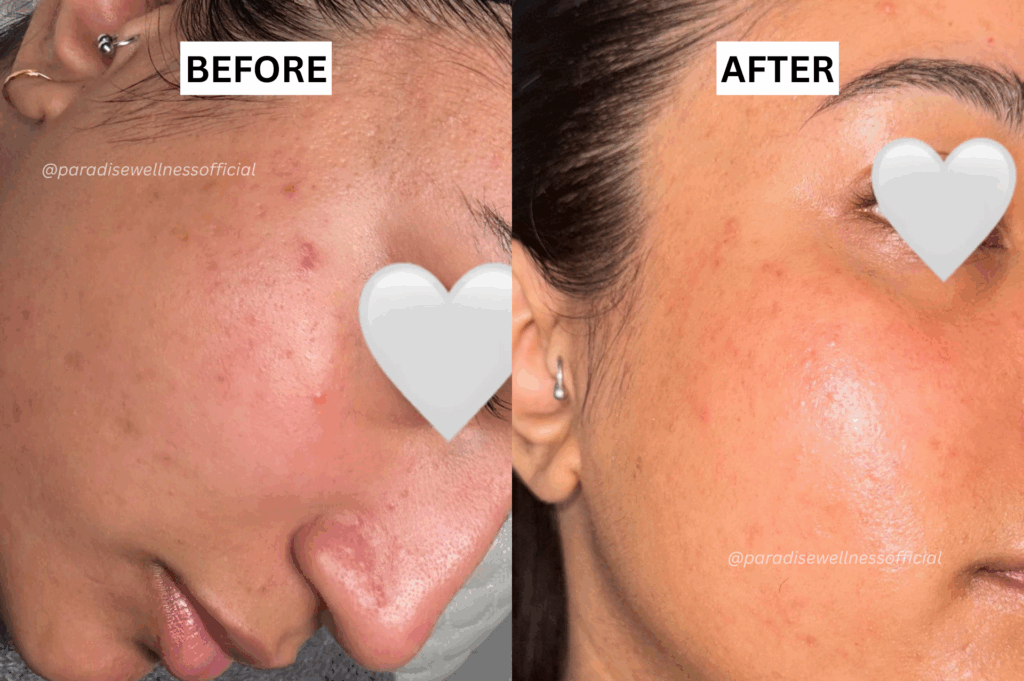 BioRePeel Before after real result at paradise wellnes delhi's best skin clinic