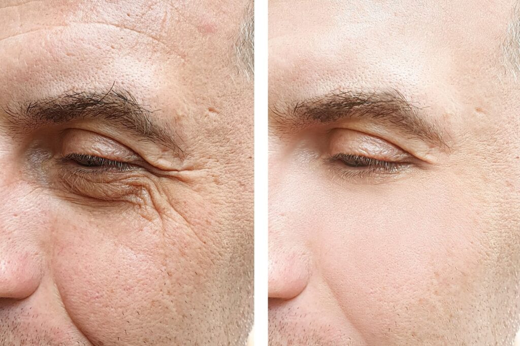 Before and after results of anti-aging treatments on forehead wrinkles