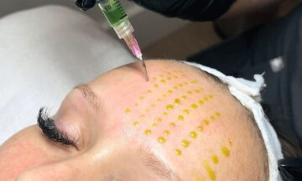 Best Treatment for Pigmentation: 5 Reasons BioRePeel Beats Chemical Peels for Glowing Skin