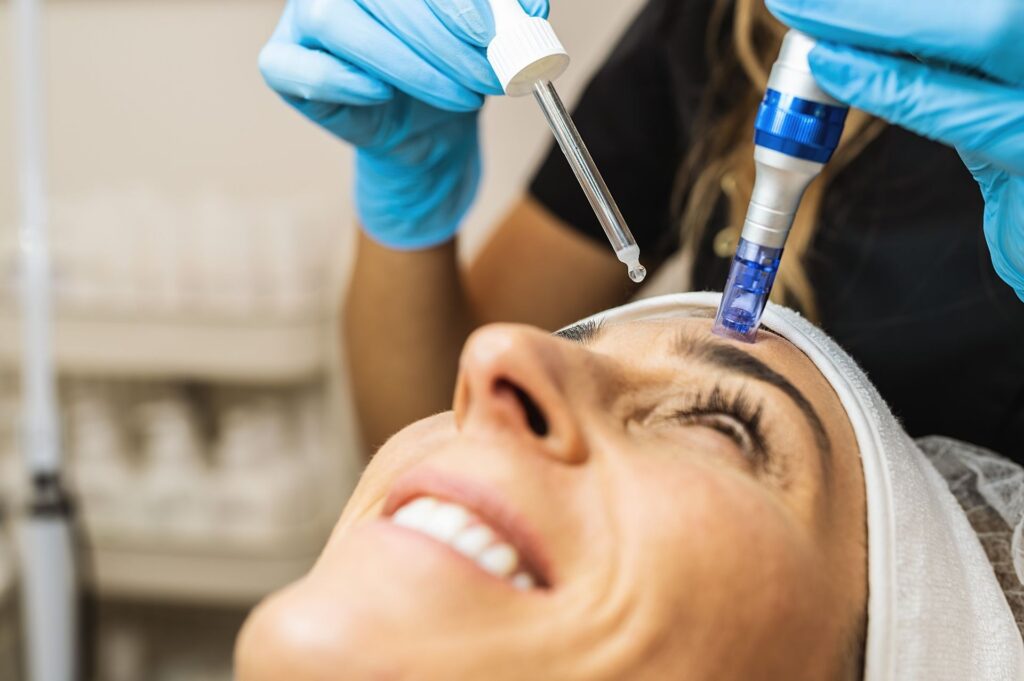 Microneedling for acne scars and pigmentation correction