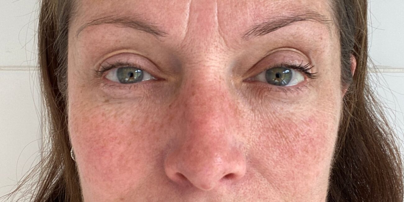 Best Skin Treatment for Pigmentation? Before and after pigmentation treatment results on Indian skin at Paradise Wellness Clinic
