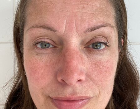 Before and after pigmentation treatment results on Indian skin at Paradise Wellness Clinic