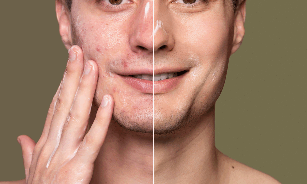 BioRePeel Vs Chemical Peels Which One is Better lets check our blog
