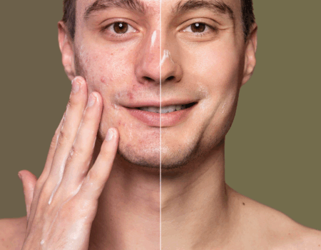 BioRePeel Vs Chemical Peels Which One is Better lets check our blog