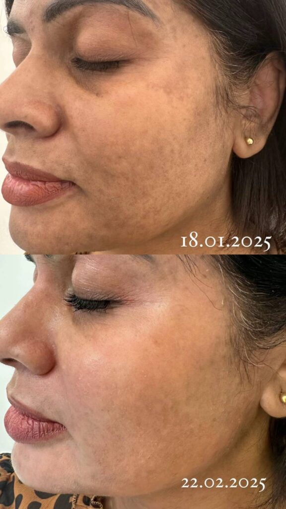 Before and After Pigmentation Treatment at Paradise Wellness