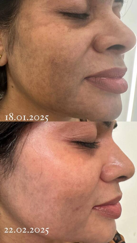 Before and After Cosmelan Peel Treatment