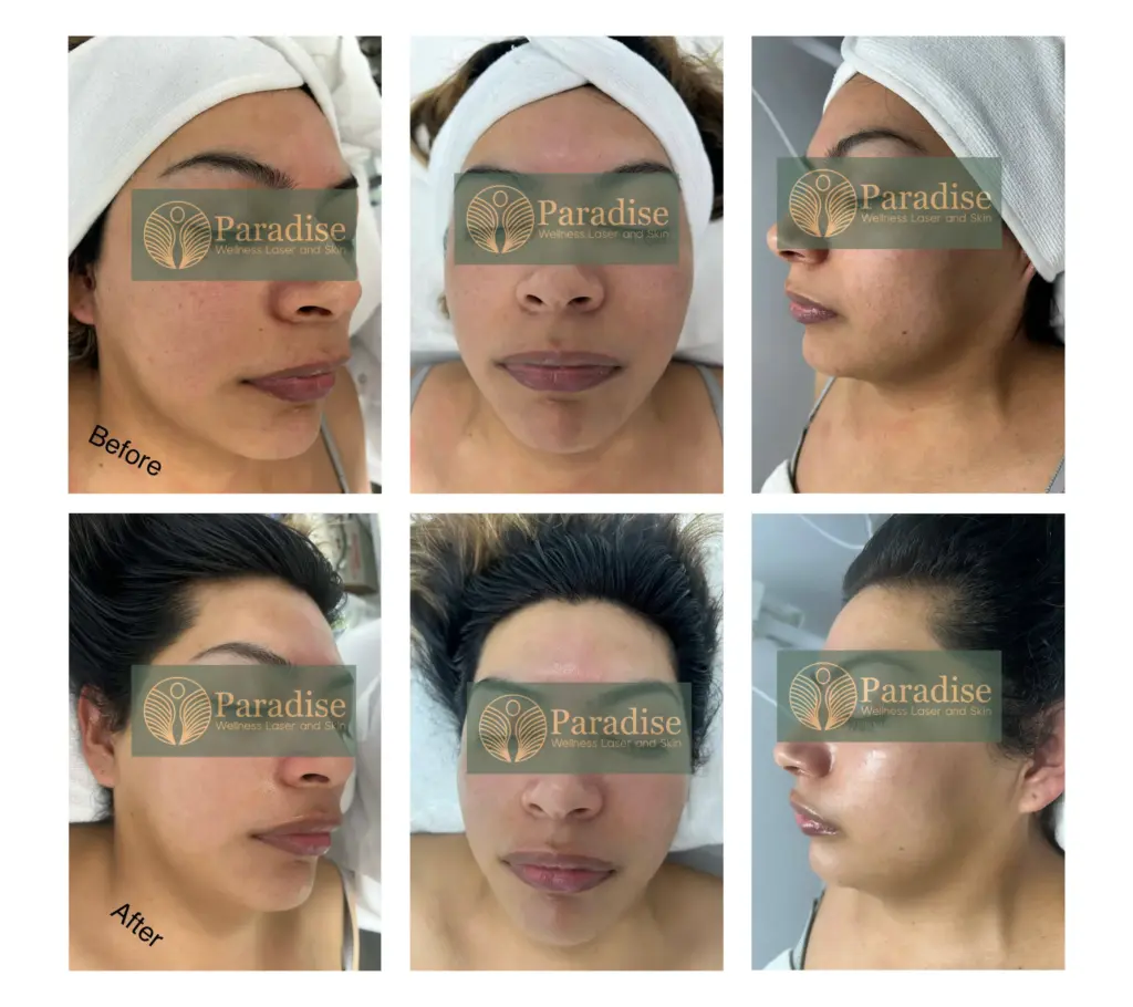Before and After HydraFacial Treatment in delhi at Paradise Wellness