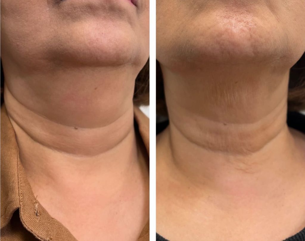 Before and After Lemon Bottle Injection