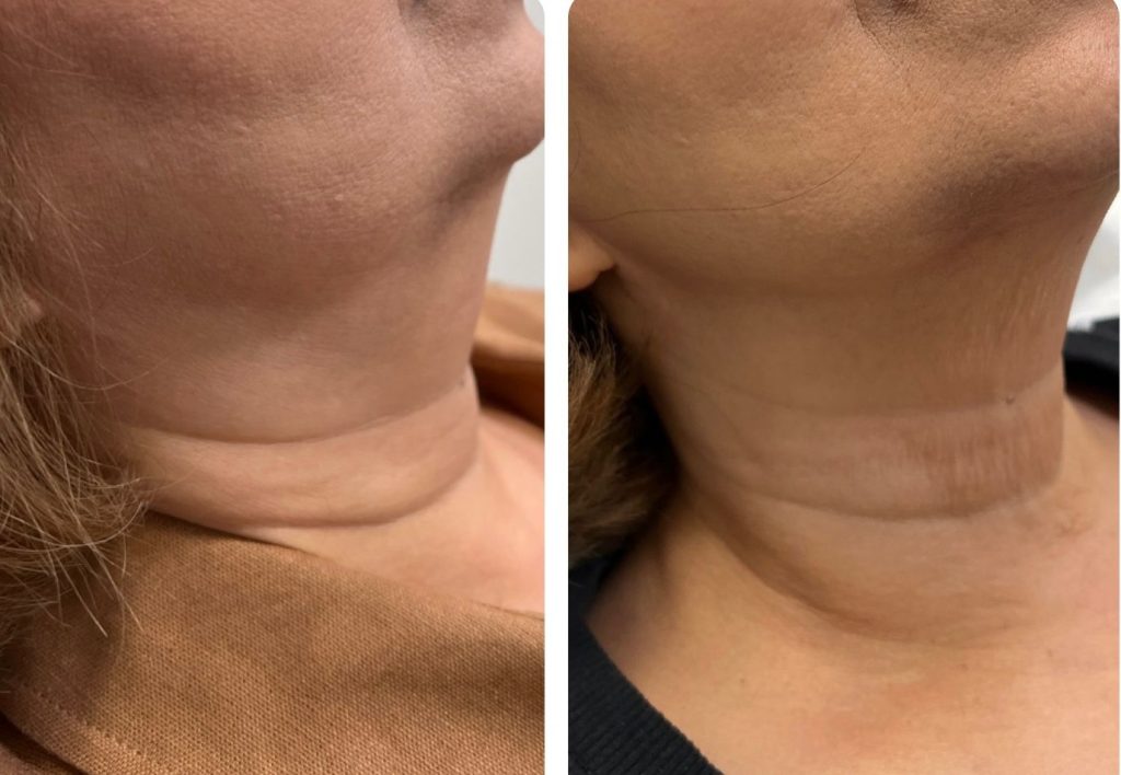 Before and After Lemon Bottle Injection for Chin Fat
