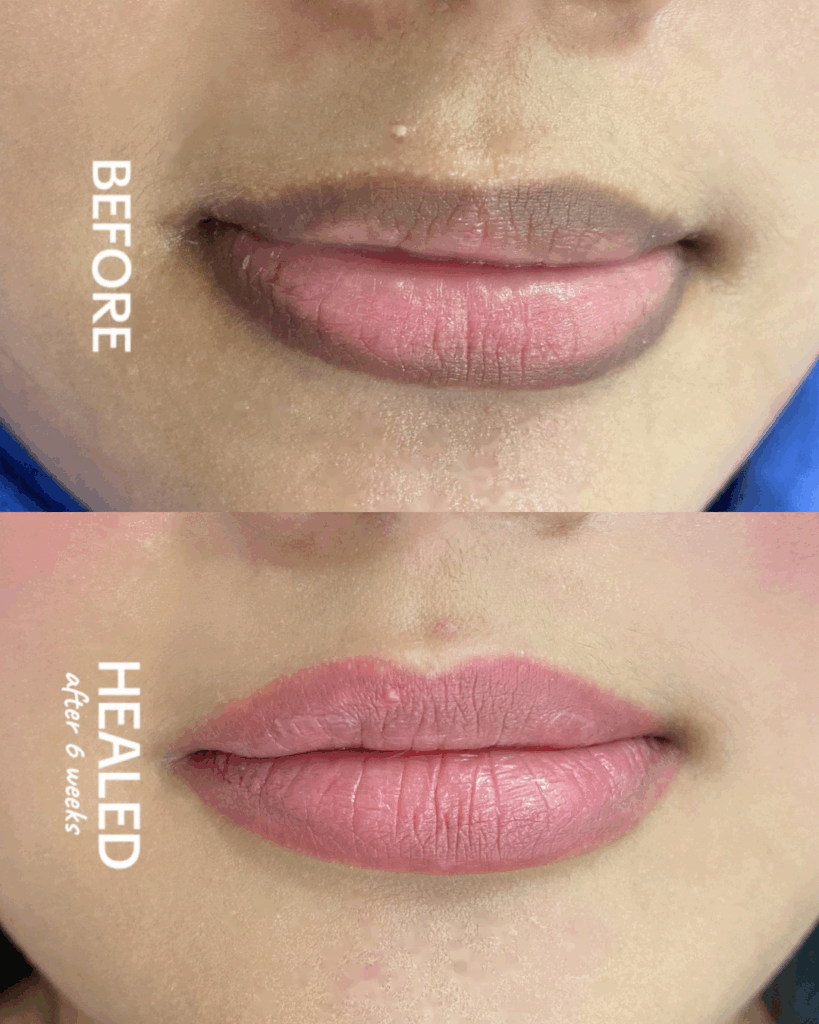 Before and After Pink Lip Treatment Single session