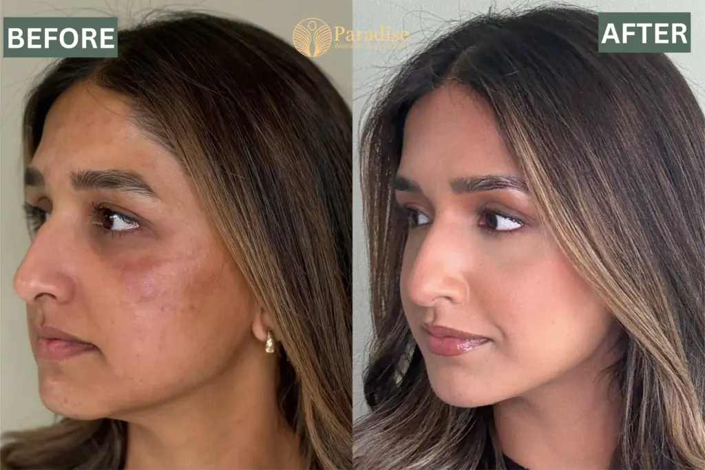 Facial Balancing Before and after 3