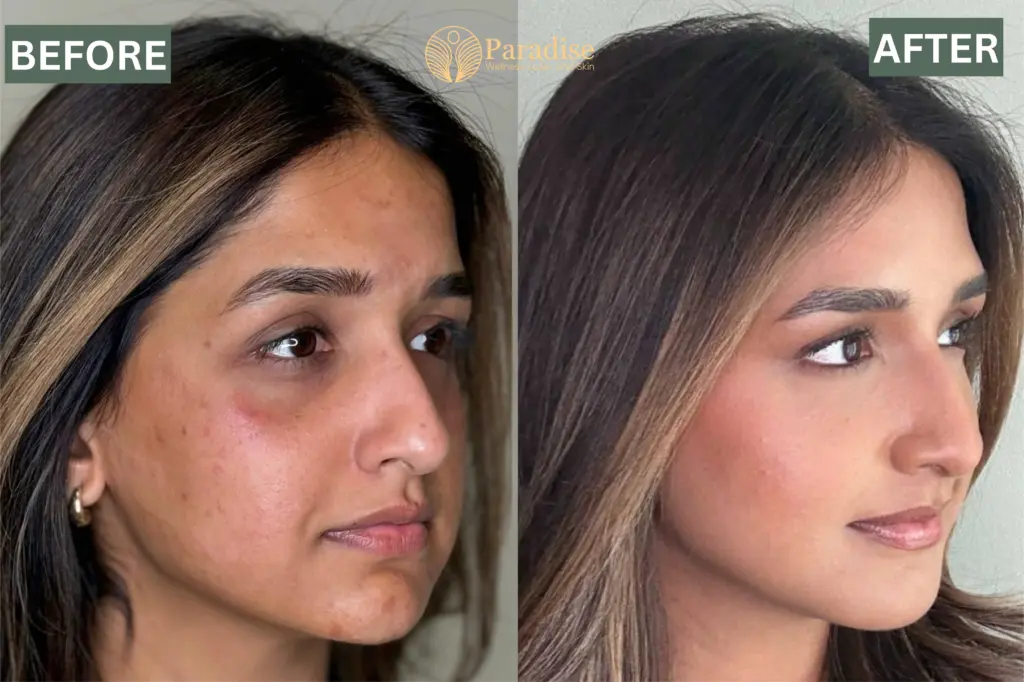 Facial Balancing Before and after 2