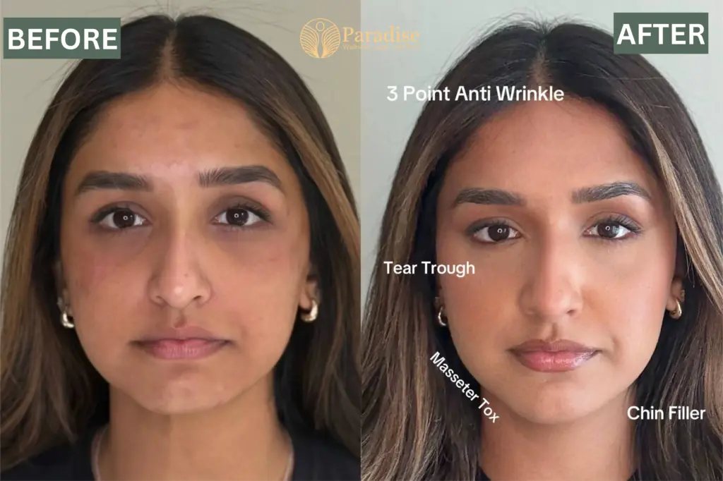 Facial Balancing Before and after 