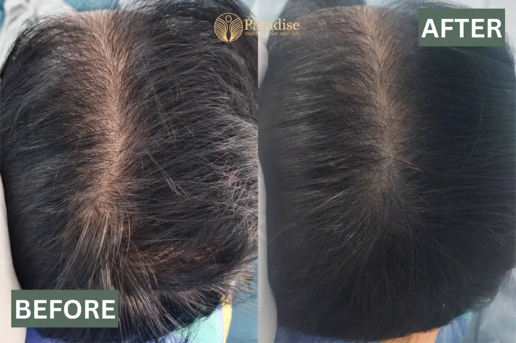 Before and after Hair Genex treatment in Paradise clinic