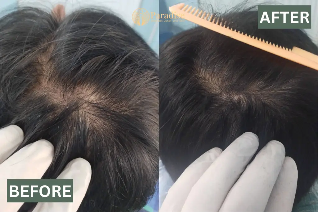 Before and after Hair Genex treatment