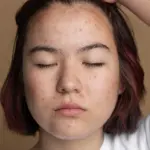 Best Treatments for Open Pores in India
