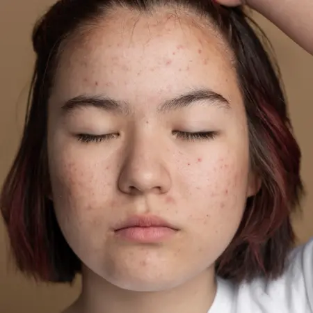 Best Treatments for Open Pores in India