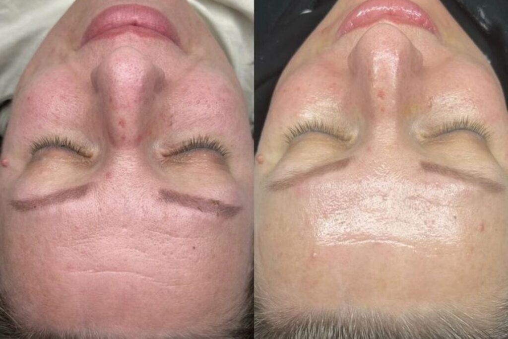 Biorepeel treatment before and after