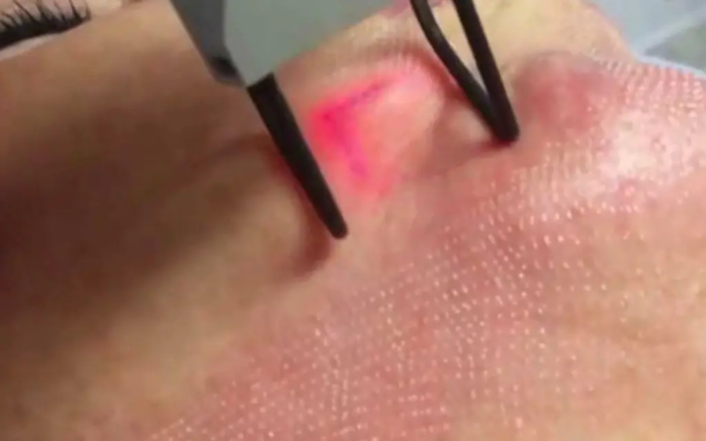 Fractional CO2 Laser