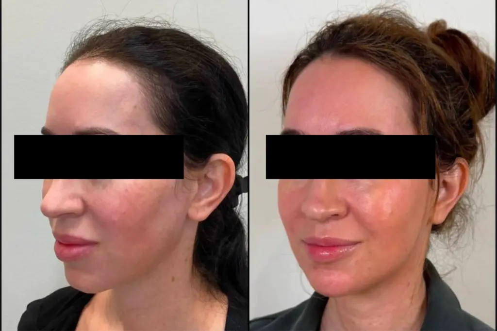 Glowpin Treatment before and after results showing improved skin texture and glow in Delhi