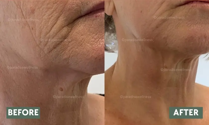 Non-surgical facelift with HIFU — jawline tightening before and after photo