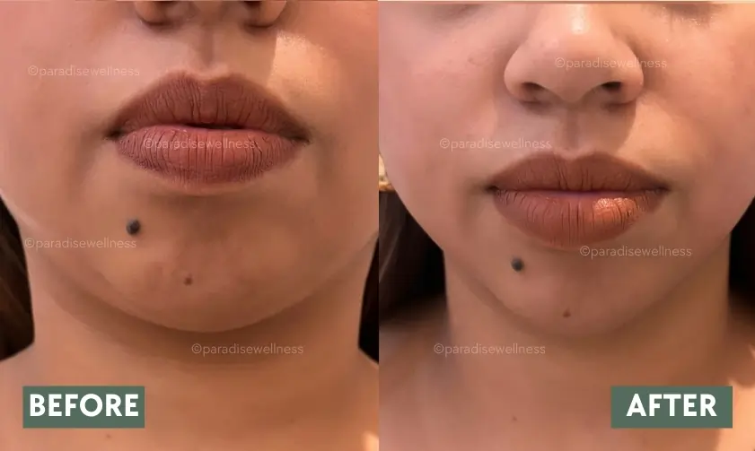 HIFU Face Treatment results – lifted cheeks and neck area before & after