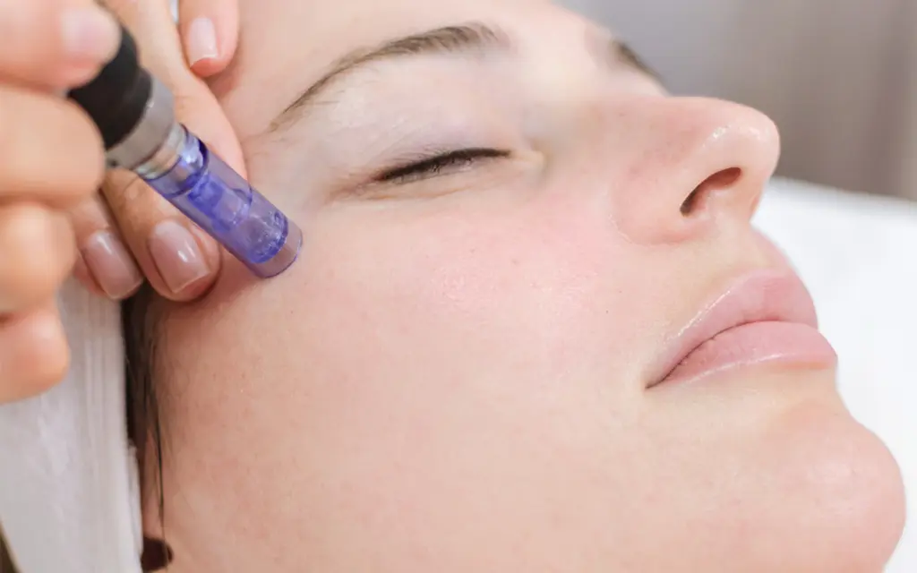 Microneedling (Derma Roller or RF Microneedling)