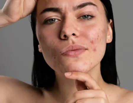 Monsoon Skin Care Hacks by Dr. Surabhi Sharma