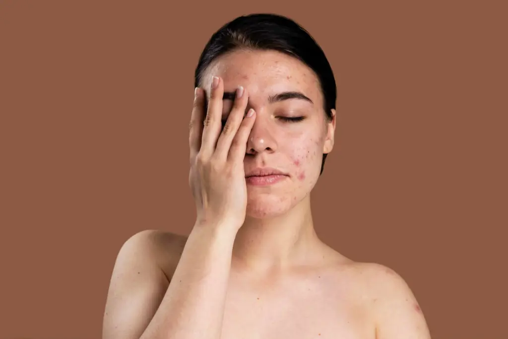oily skin in monsoon