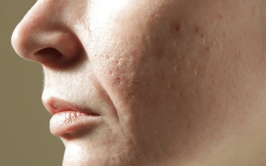 Top 5 Best Treatments for Open Pores