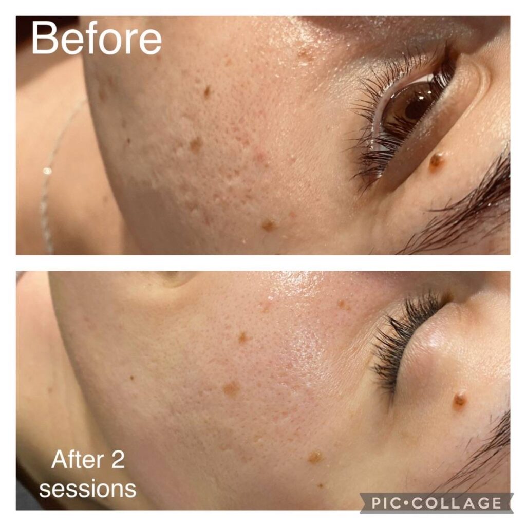 Open Pores Reduction Results with Laser and Chemical Peel