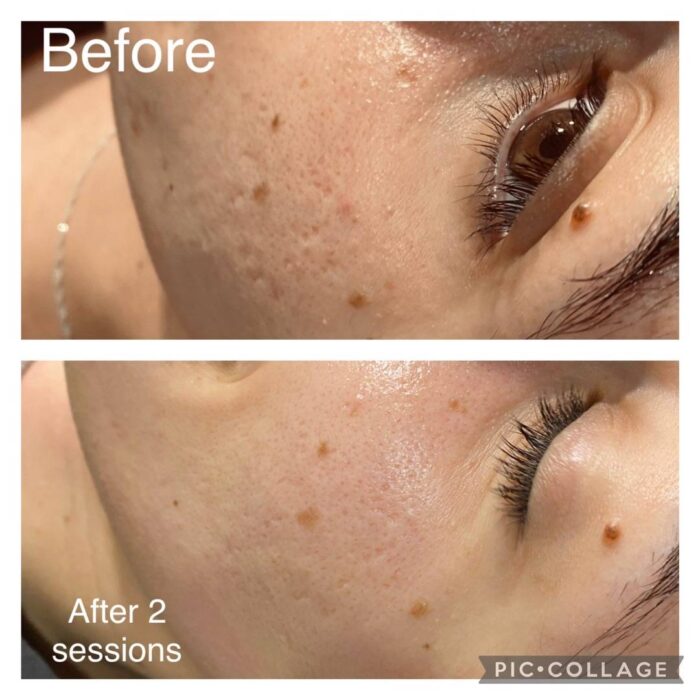 Top 5 Best Treatments For Open Pores In India Paradise Wellness Top 5 Best Treatments For Open Pores In India Paradise Wellness