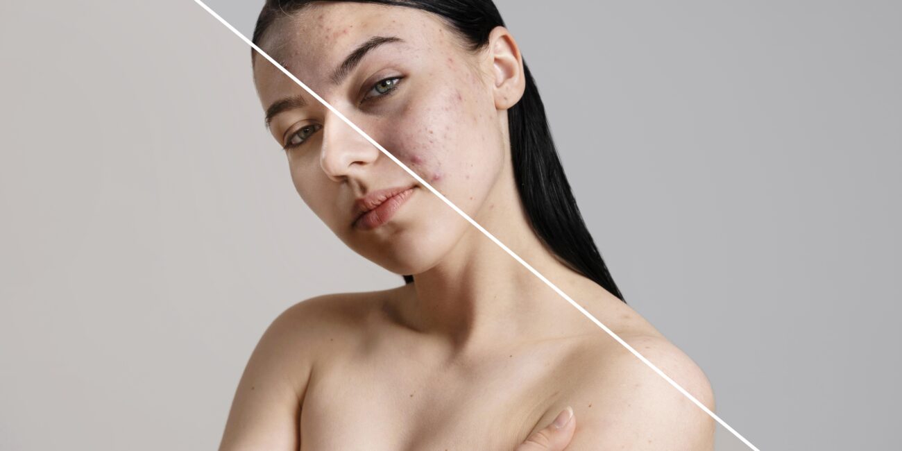 Cosmelan Peel for Pigmentation women before and after image