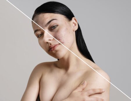 Cosmelan Peel for Pigmentation women before and after image