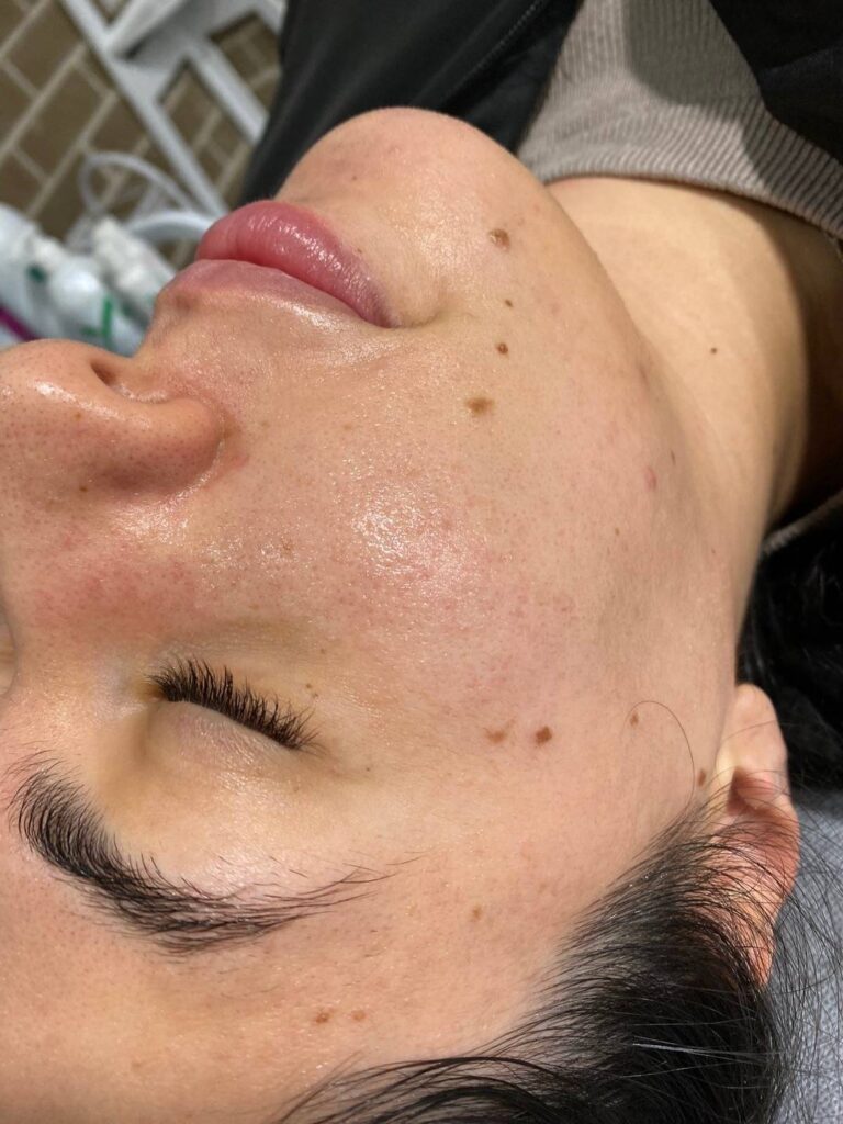 Open Pores Reduction Results with Laser and Chemical Peel