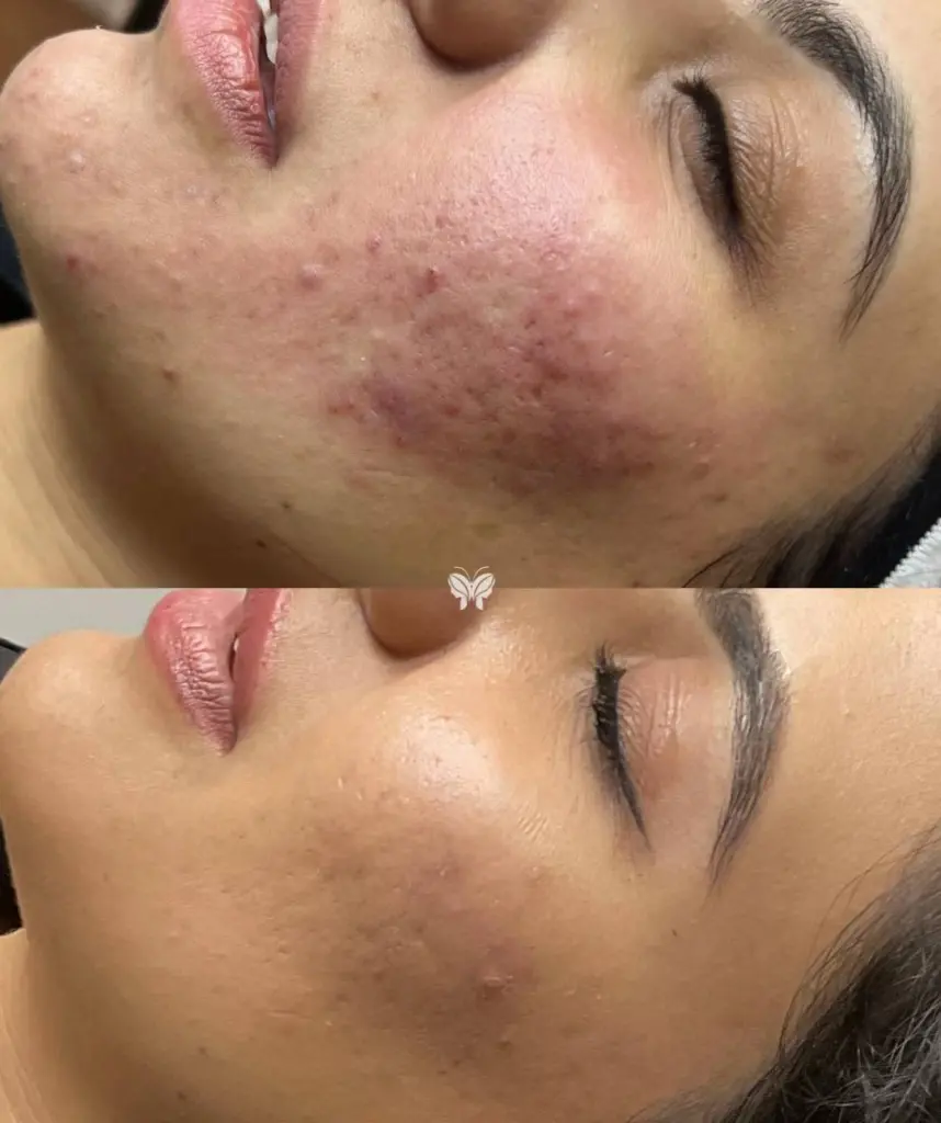 Skin Rejuvenation Before and After ExoCoBio Exosome ASCE Plus SRLV at Paradise Wellness