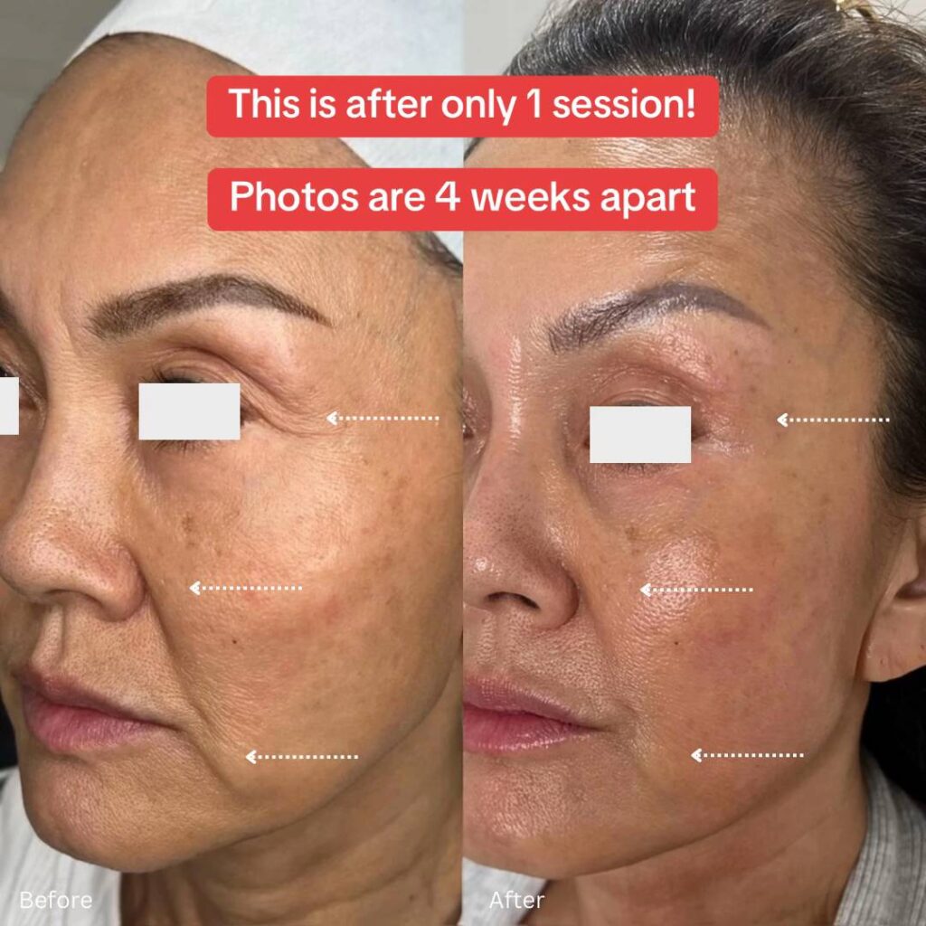 Before and After Salmon DNA Facial Treatment at Paradise Wellness Clinic Delhi