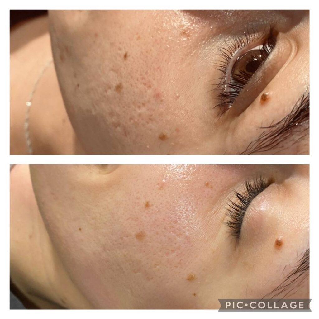 Before and After Open Pores Treatment