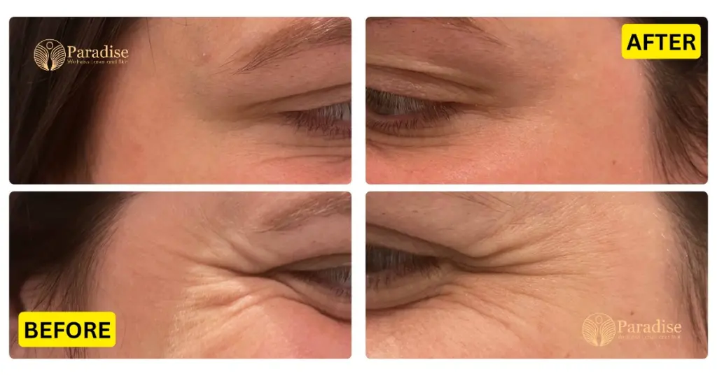 Before and After Allergan Botox Treatment Delhi – Paradise Wellness