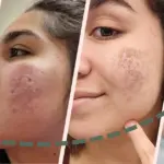 Before and After Glow Infusion Treatment Delhi