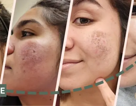 Before and After Glow Infusion Treatment Delhi