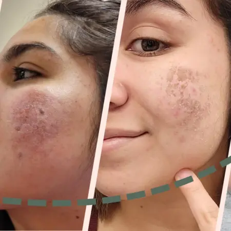 Before and After Glow Infusion Treatment Delhi