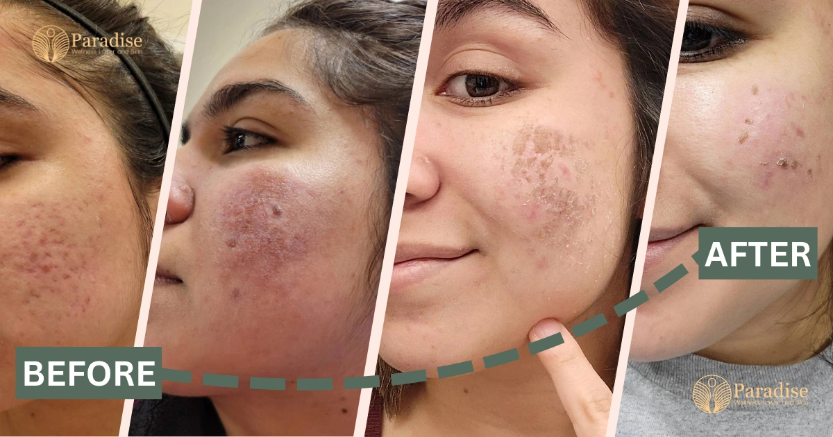 Before and After Glow Infusion Treatment Delhi