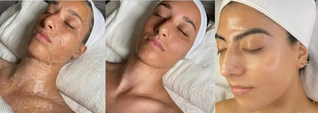 Before and after results of enzyme therapy treatment in Delhi