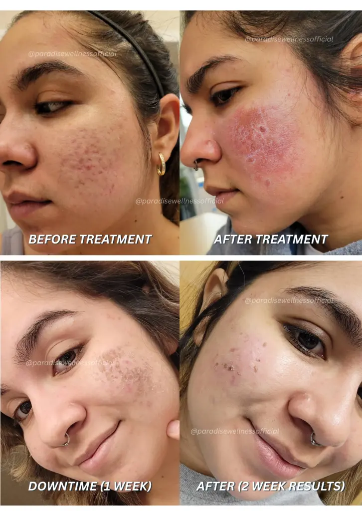 Before and After Glow Infusion Treatment Delhi – Paradise Wellness