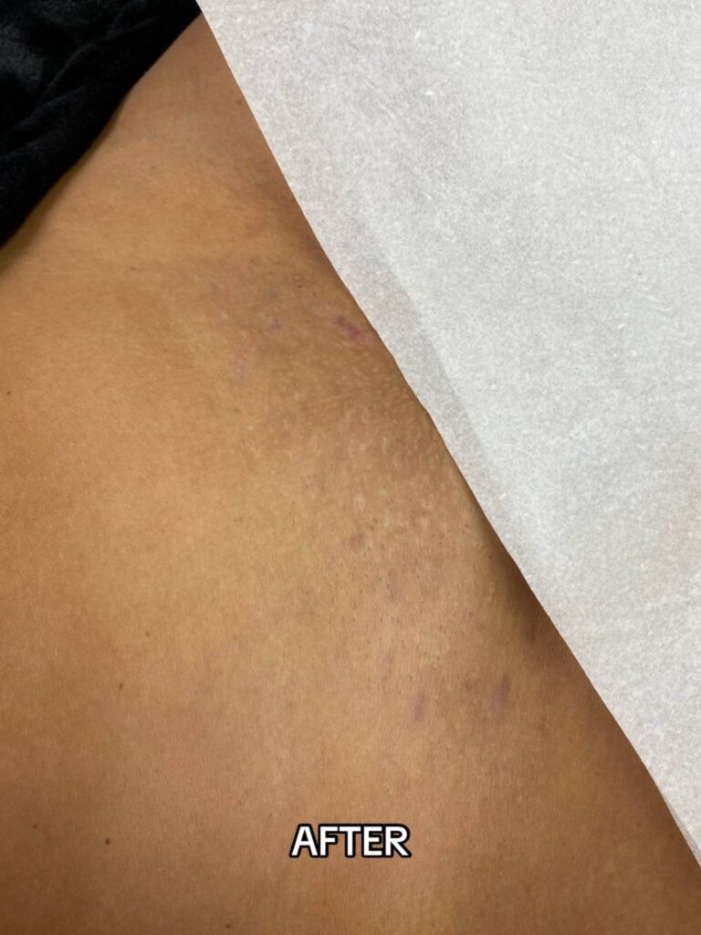 After Laser Hair Removal Side Effects on Bikini Area at Paradise Wellness