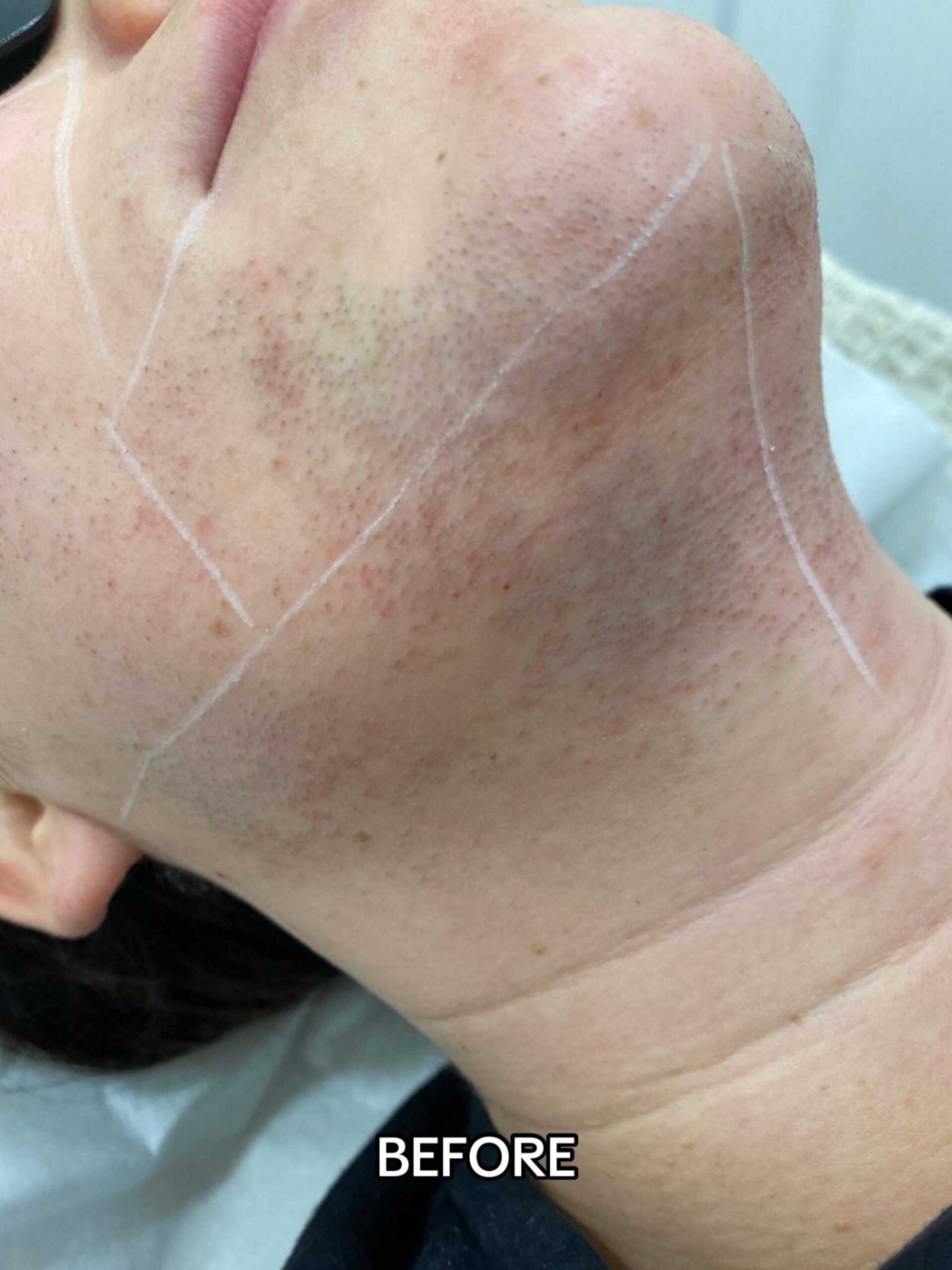 Before Laser Hair Removal Side Effects on Face at Paradise Wellness