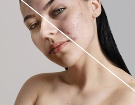 Cosmelan Peel for Pigmentation women before and after image