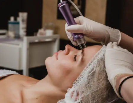 Microneedling with Exosomes